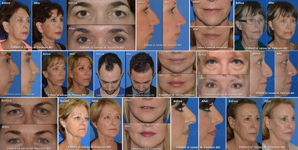 Manhattan Beach Plastic Surgery Gallery